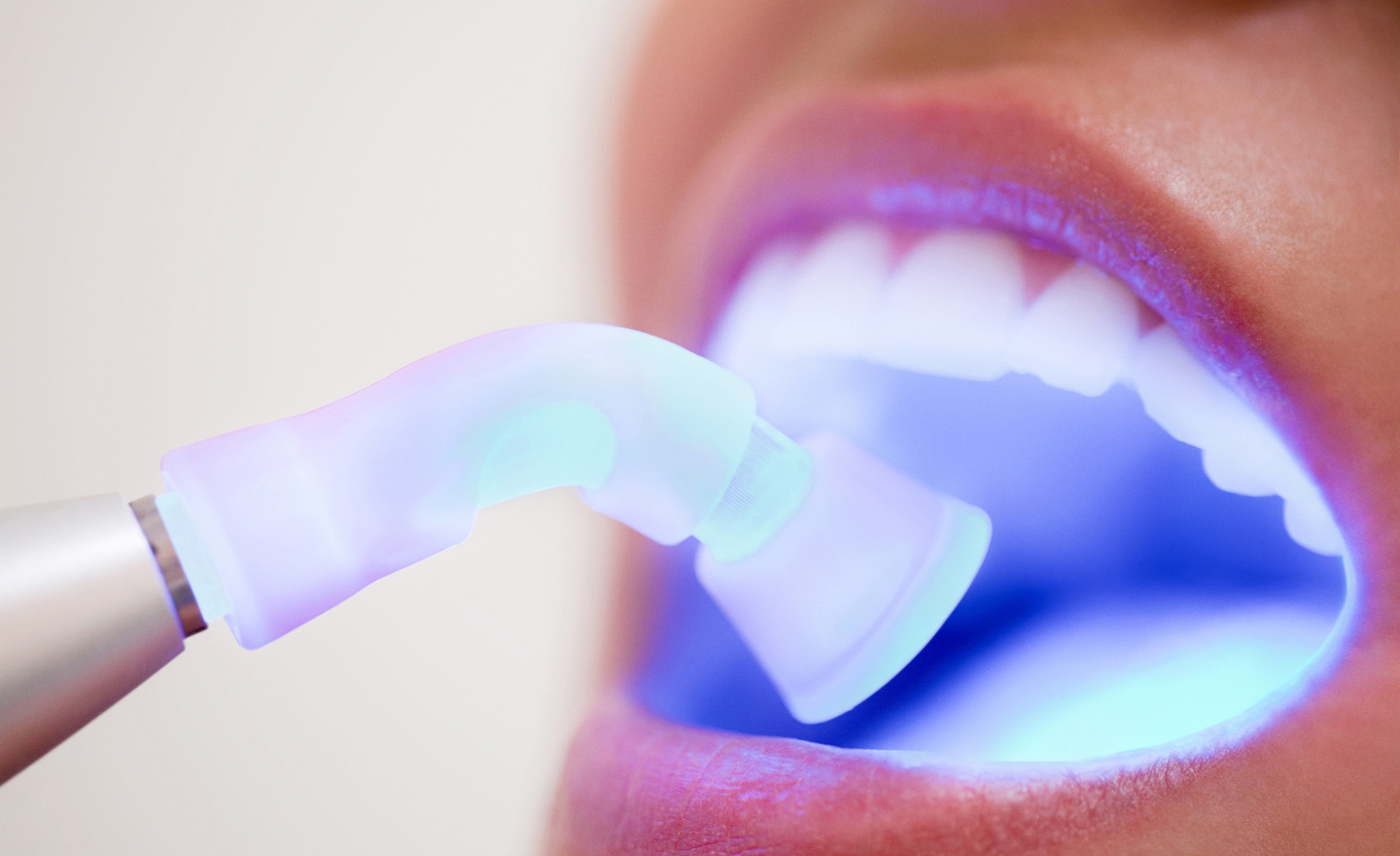 Todo lo que necesitas saber sobre los empastes dentales: duración, procedimiento y causas